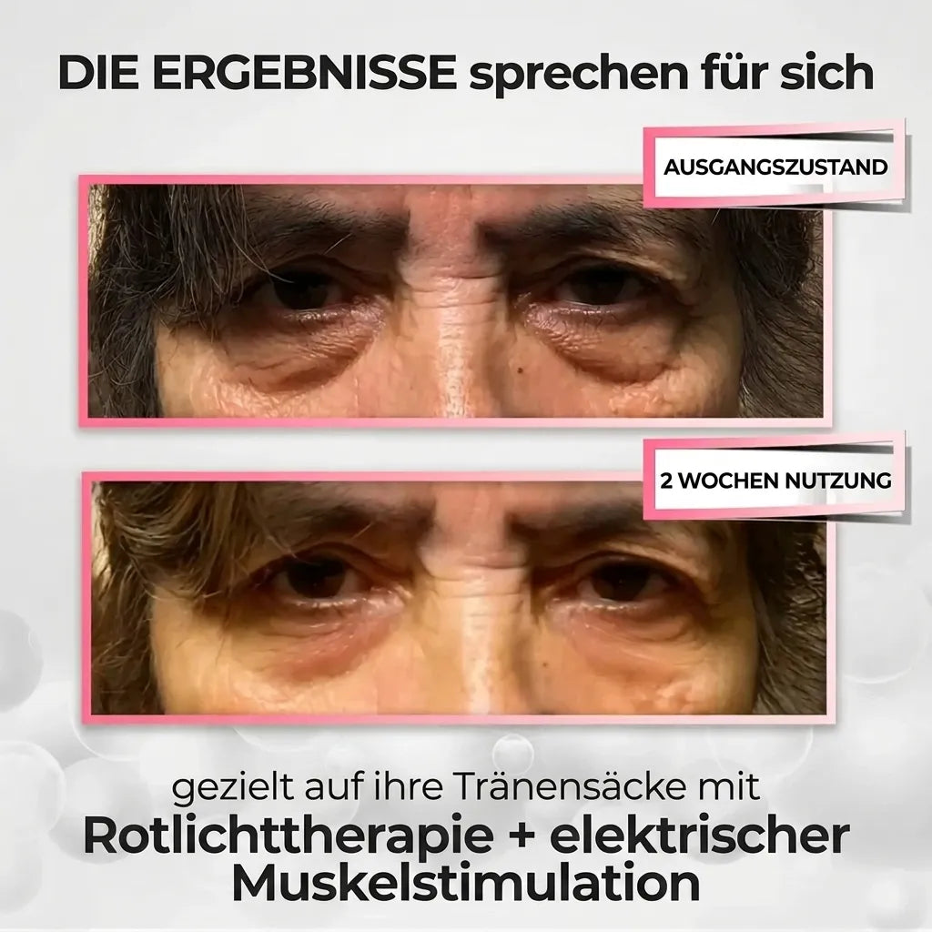 LuminEyes® 2-in-1 Rotlicht-Therapie + EMS Um Tränensäcke Loszuwerden