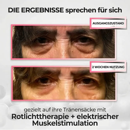 LuminEyes® 2-in-1 Rotlicht-Therapie + EMS Um Tränensäcke Loszuwerden